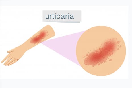 Recurrent red hives (urticaria)