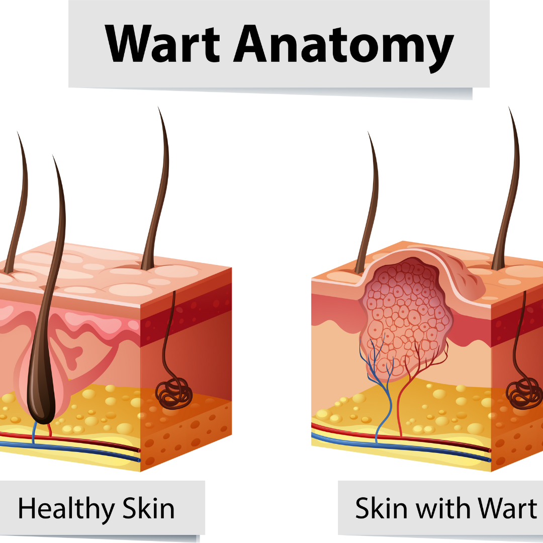 Warts cause, Symptoms, and Homeopathic Treatment Caitanya Healing